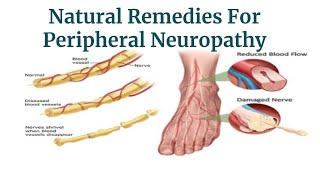 NATURAL CURE TO PERIPHERAL NEUROPATHY [upl. by Morganstein]