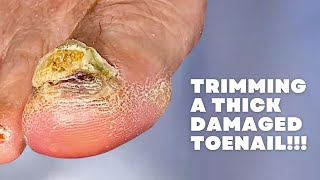 Trimming a THICK DAMAGED Toenail [upl. by Ferna]