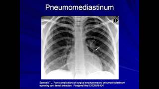 Lung Protective Ventilation Mechanical Ventilation  Lecture 9 [upl. by Kral657]