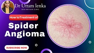 Spider Angioma cause and Treatment radiating blood vessels on skin  Dr Uttam Kumar Lenka [upl. by Gnen200]