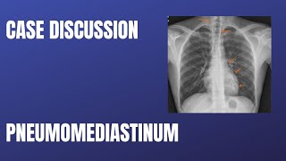 Case Discussion  Pneumomediastinum [upl. by Adelpho]