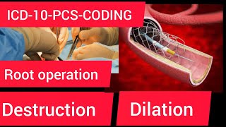 ICD10PCS codingRoot operation destruction amp dilation [upl. by Lertsek]