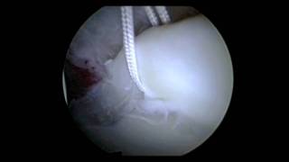 Hip Arthroscopy Labral Repair Surgery  Repair Torn Hip Labrum  Dr David J King [upl. by Schnurr316]