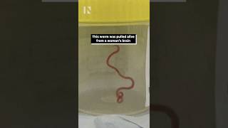 Surgeon removes live worm from woman’s brain shorts [upl. by Puiia]