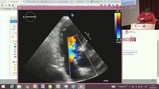 Máster Técnico en Ecocardiografía Tutoría 3 [upl. by Ecraep]