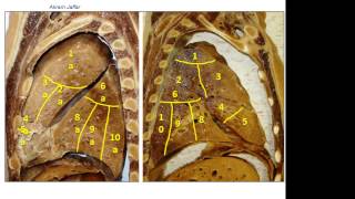 Bronchopulmonary segments of the lungs [upl. by Harim]