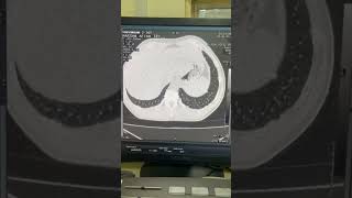 Diffuse parenchymal lung Disease HRCT chest lungdiseasesteaching hrct ILD [upl. by Asenad]