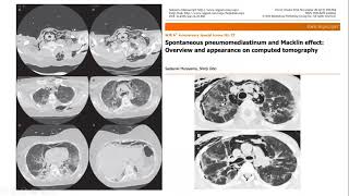 Pneumomediastinum and COVID [upl. by Ennayhs62]