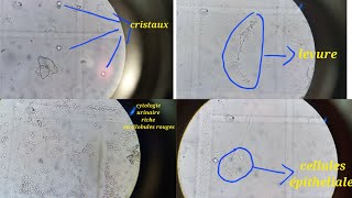 les différents éléments dans la cytologie urinaire [upl. by Capello]