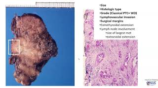 Thyroid carcinoma II Pathology evaluation [upl. by Assiron]