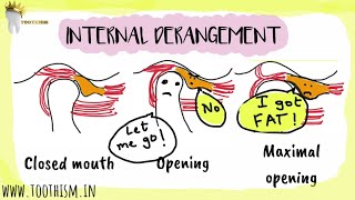 INTERNAL DERANGEMENT Anterior Disk Displacement  Temporomandibular Joint [upl. by Reace]