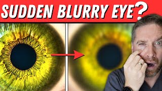 Sudden Blurry Vision In One Eye 5 Causes [upl. by Idner]