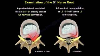 Evaluation of S1 nerve Root motor sensory and reflex evaluation of S1 in contrast to L5 root [upl. by Davidson979]