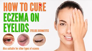 How to cure eczema on eyelids  Eyelids Dermatitis treatment and natural home remedies 2021 [upl. by Eidroj627]