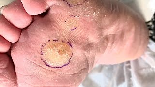 Callus removal from feetampFoot scraping dead skin [upl. by Eugilegna]