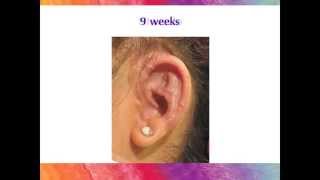 Microtia Ear Surgery  The Healing Process with the Porous Implant Ear Reconstruction technique [upl. by Nue891]