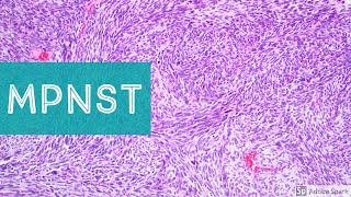 Malignant Peripheral Nerve Sheath Tumor MPNST 101Explained by a Sarcoma Pathologist [upl. by Darrej]