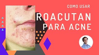 Como usar isotretinoina e roacutan para acne e espinhas [upl. by Eicyaj]