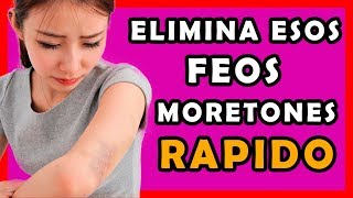 Como quitar los moretones o hematomas de la piel con estos remedios caseros [upl. by Rachele]