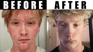 How I Cleared My Acne No Bullsht Guide [upl. by Aniehs]