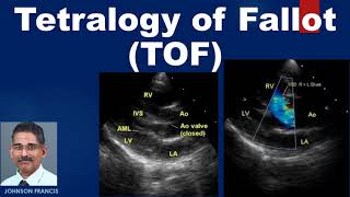 Tetralogy of Fallot TOF [upl. by Koeppel74]