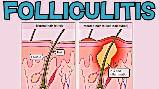 What is Folliculitis Folliculitis EXPLAINED in 2 Minutes  Signs Symptoms Cause Treatment [upl. by Dnaletak]