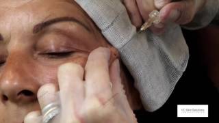 Full face Rejuvenation with Pluryal Dermal Fillers Dr Sabine ZENKER [upl. by Aikkan]