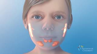 Salivary Gland Ablation  Treatment for Ranulas or Sialorrhea excessive drooling [upl. by Abihsat]