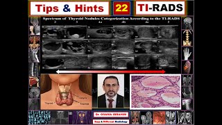 Tips amp Hints 22 TI RADS how to score thyroid nodule [upl. by Ontina473]