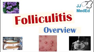 Folliculitis  Causes Bacterial Fungal Viral Risk Factors Symptoms Diagnosis Treatment [upl. by Lexa]