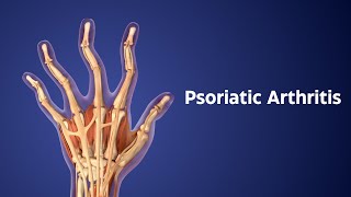 Title Understanding Psoriatic Arthritis Symptoms Treatment and Early Signs [upl. by Riada]