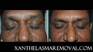 Xanthelasma removal at home without scarring the most time saving and cost effective solution [upl. by Atikaj]