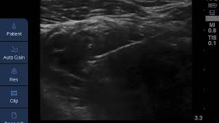 Proximal approach for ultrasoundguided infraclavicular brachial plexus block [upl. by Kliment]