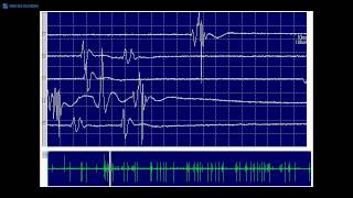 Kimura amp Kohara F32 Typical fasciculation potentials [upl. by Leviram]