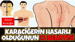 12 Belirti Karaciğerinizde Sorun Olduğunu Gösterir [upl. by Nodnar121]