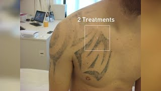 PicoSure Laser TattooRemoval  Before and afters  Zapp Laser Studio [upl. by Fawnia]