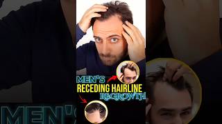 Receding Hairline regrowth derma roller hair mensgrooming [upl. by Esela]