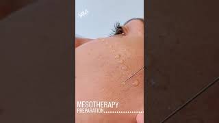 Mesotherapy Facial Treatment Benefits Procedure amp FAQ  EDEN AESTHETICS Dubai [upl. by Helen962]