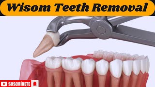 Wisdom Teeth Removal Do You Really Need It StepbyStep Procedure Explained 3D animation  MHCP [upl. by Elleirad]