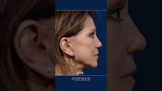 Facelift Before amp After  10 year Facelift Results [upl. by Gallenz176]