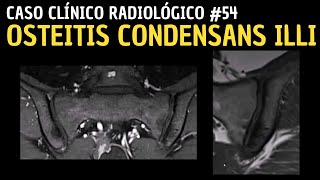 Caso Clínico Radiológico 54 Osteitis Condensans Illi [upl. by Cartan]