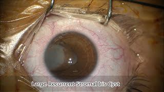 Aspiration of large recurrent stromal iris cyst [upl. by Mcclure]