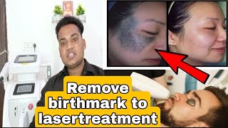 Remove birthmark to lasertreatment 🥰Remove birthmark [upl. by Wenonah]