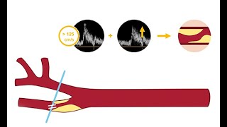 Identifying carotid artery disease with ultrasound [upl. by Cheung]