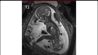 sacrococcygeal teratoma type 1 [upl. by Benedix142]