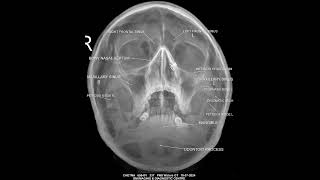 Medical Image in X ray PNS Paranasal sinus on reading paramedical medical [upl. by Mailli142]