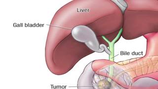 What is the Whipple Procedure  Mayo Clinic [upl. by Phylis]