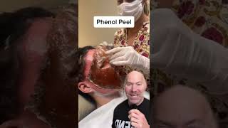 Most Powerful Chemical Peel 😱 shorts [upl. by Sileas983]