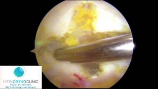 Hanche arthroscopie  Décompression de la bandelette iliotibiale par voie sous cutanée [upl. by Ailito]