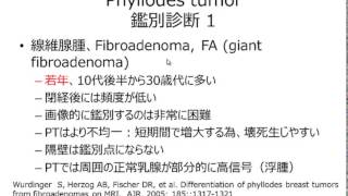 Phyllodes tumor answer 20140707 WMV [upl. by Rayham274]